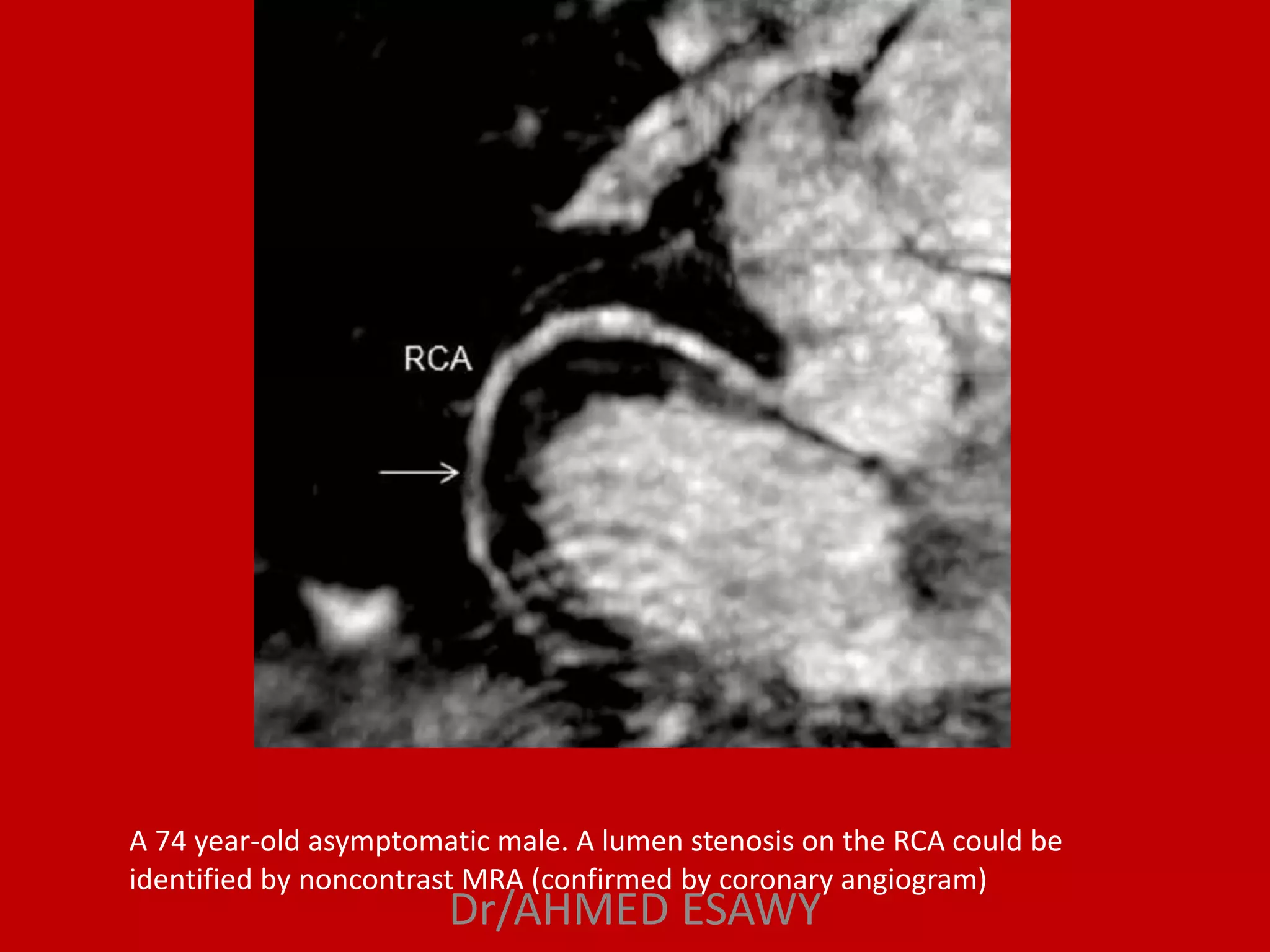 Role of magnetic resonance imaging in coronary artery disease MRCA part ...