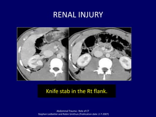 Role of mdct in blunt abdominal trauma Dr. Muhammad Bin Zulfiqar | PPTX