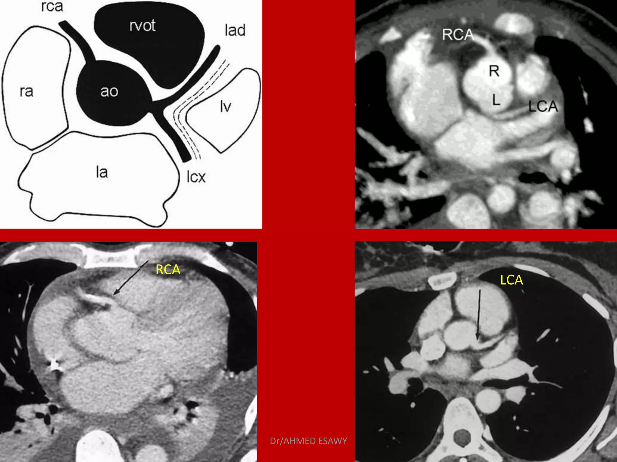 Role of MDCT in coronary artery part 1 (CT anatomy) Dr Ahmed Esawy | PPT