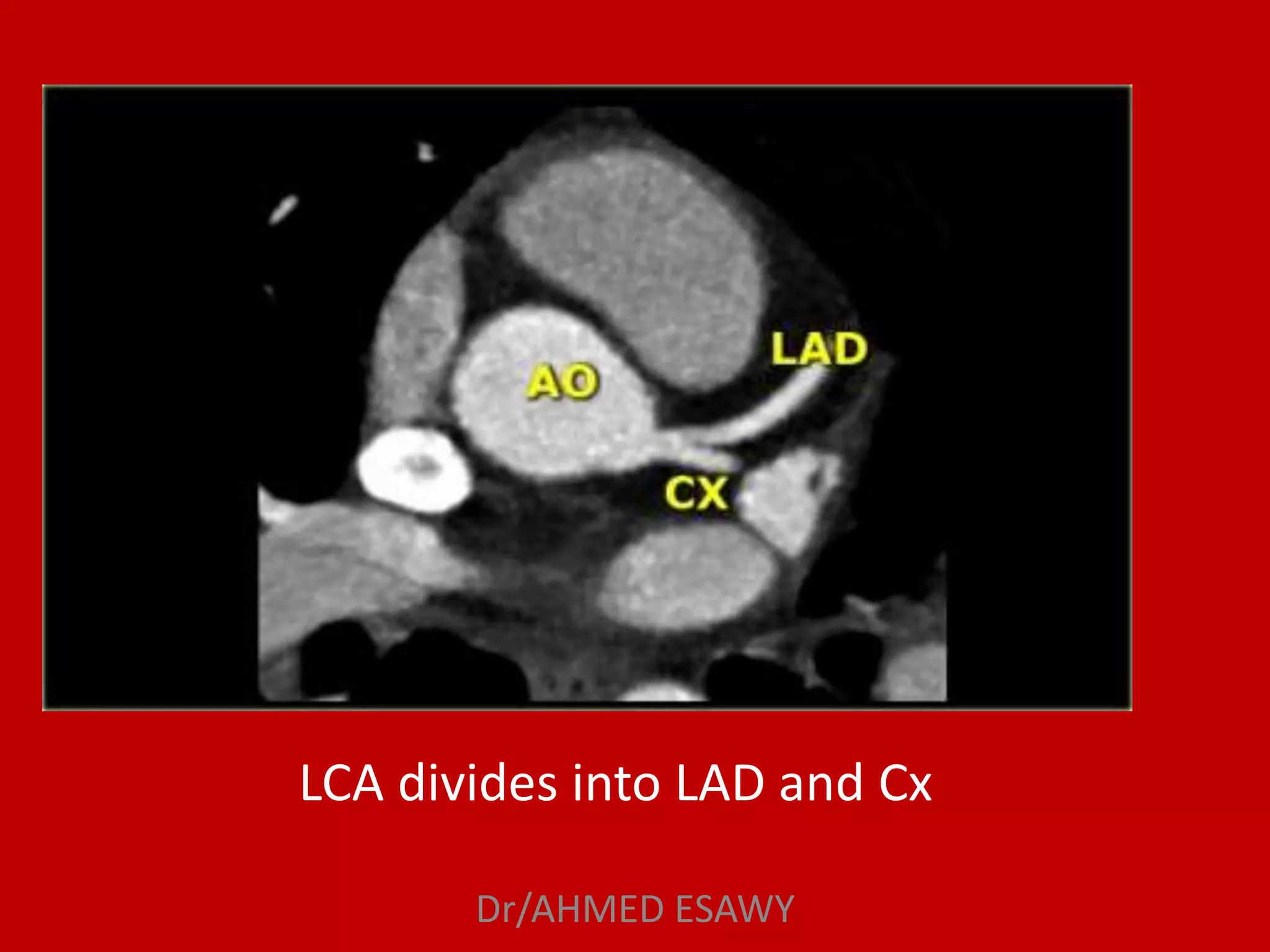 Role of MDCT in coronary artery part 1 (CT anatomy) Dr Ahmed Esawy | PPT