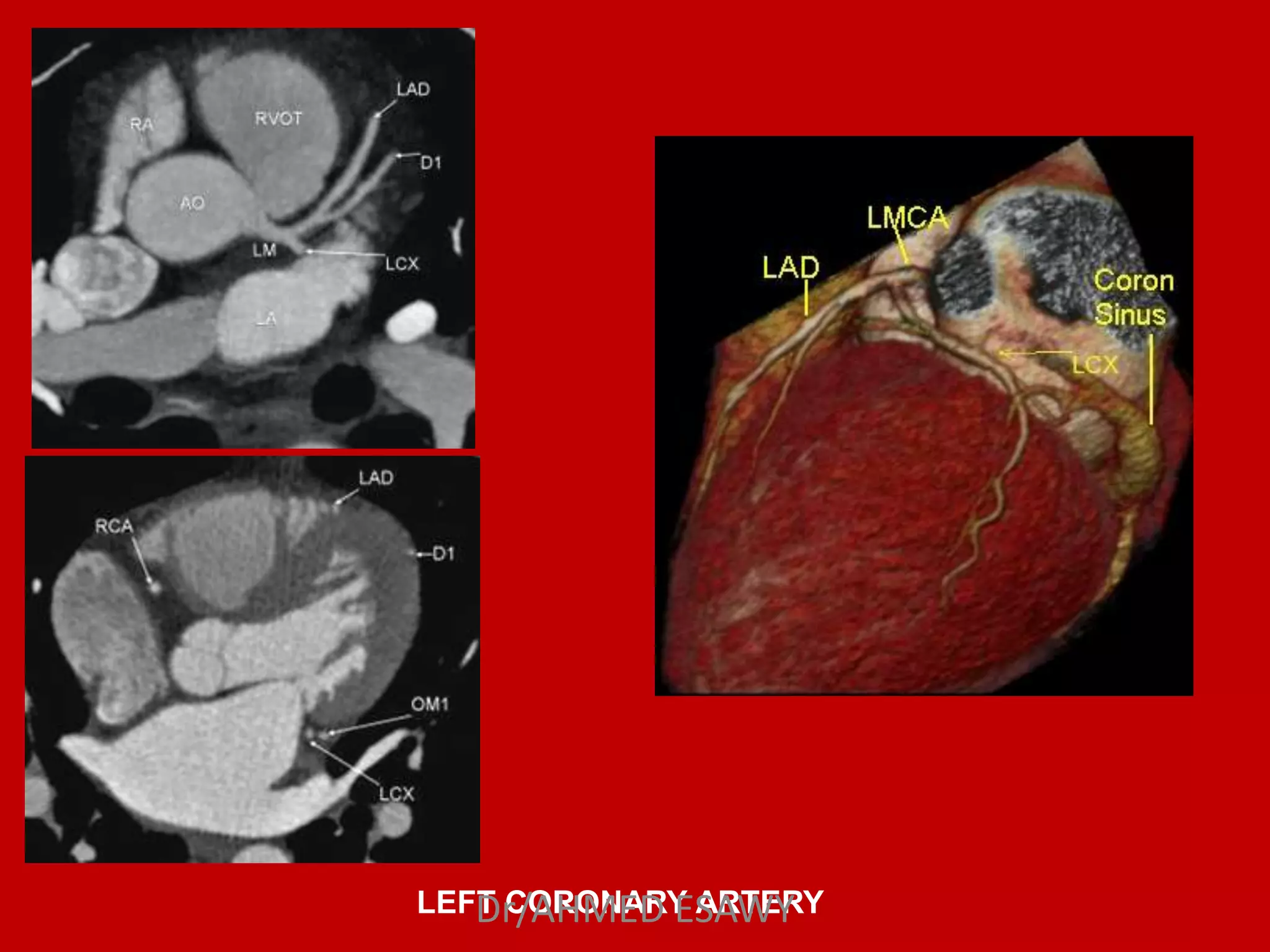Role of MDCT in coronary artery part 1 (CT anatomy) Dr Ahmed Esawy | PPT