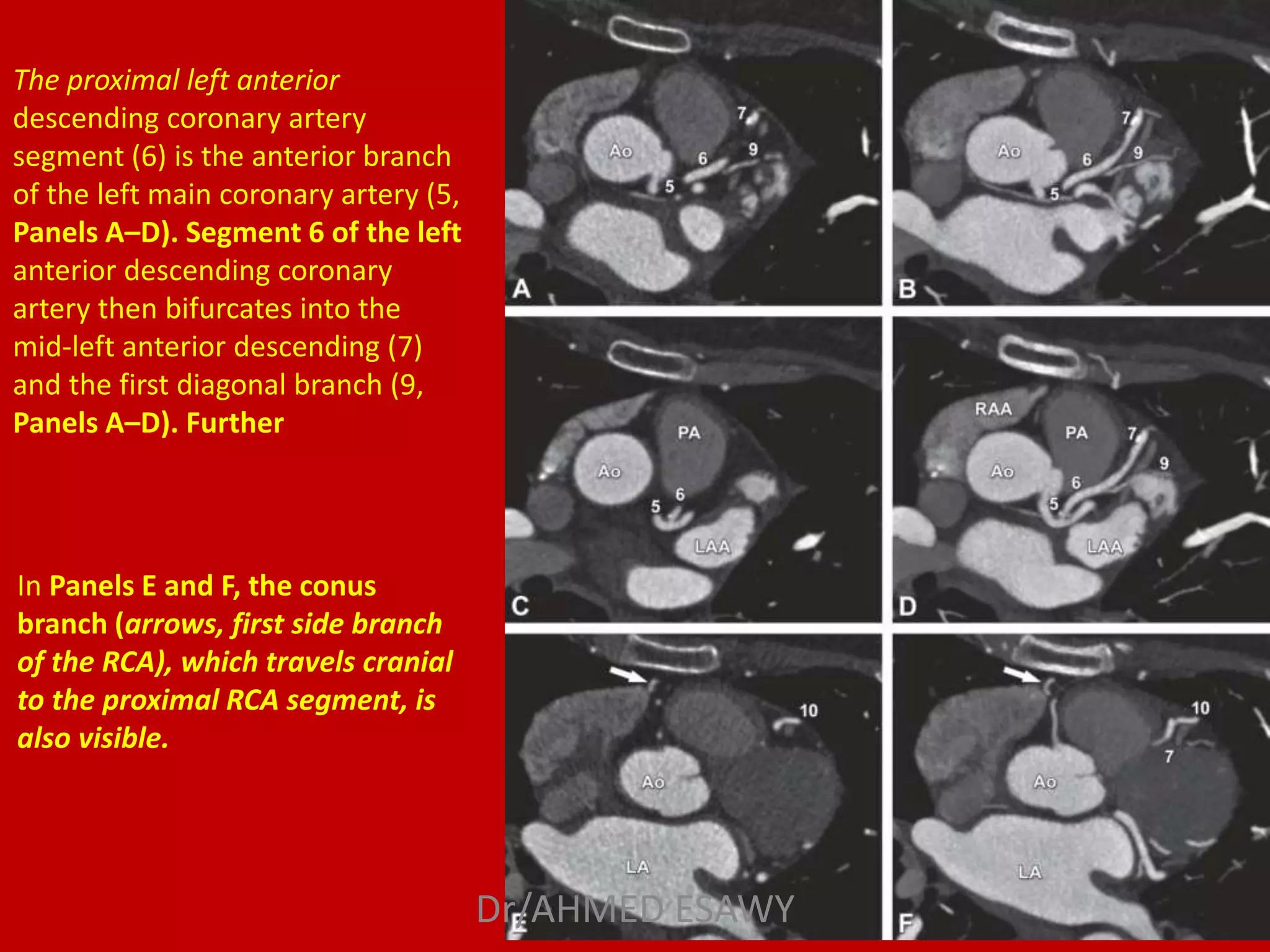 Role of MDCT in coronary artery part 1 (CT anatomy) Dr Ahmed Esawy | PPT