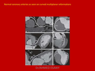 Role of MDCT in coronary artery part 1 (CT anatomy) Dr Ahmed Esawy | PDF
