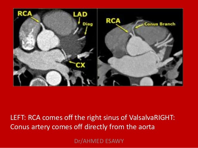 Role of MDCT in coronary artery part 1 (CT anatomy) Dr ...