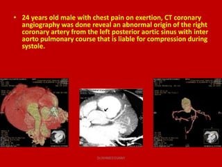 • 24 years old male with chest pain on exertion, CT coronary
angiography was done reveal an abnormal origin of the right
c...
