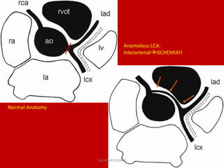 Normal Anatomy
Anomalous LCA:
InterarterialISCHEMIA!!
Dr/AHMED ESAWY
 