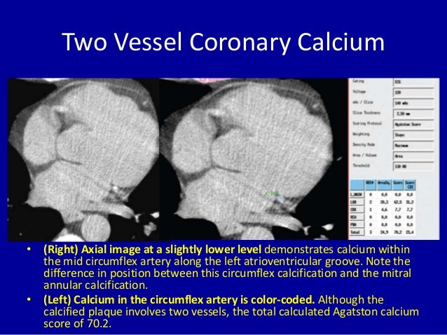 noncompressible calcified vessel meaning noncompressible calcified vessel meaning