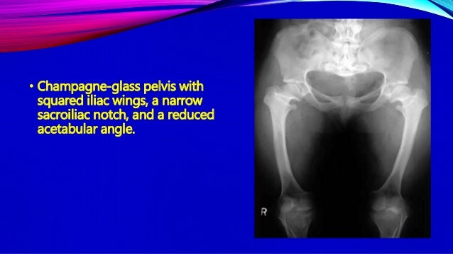 Role Of Medical Imaging In Achondroplasia Dr Muhammad Bin Zulfiqar