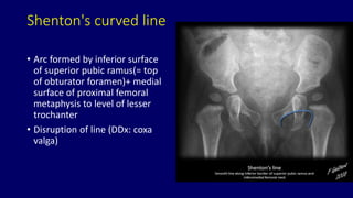Role of medical imaging in developemental dysplasia of Hip Dr muhammad ...