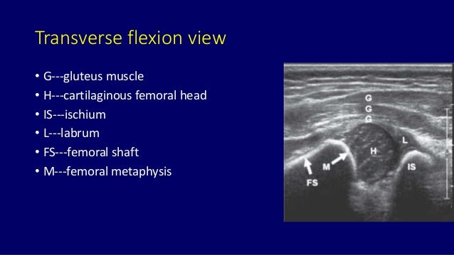 Role of medical imaging in developemental dysplasia of Hip Dr muhamma…