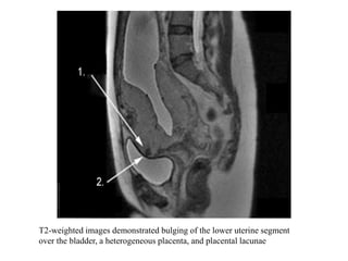 Role of mri in placental disorders new | PPTX