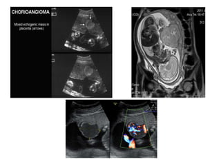 Role of mri in placental disorders new | PPTX