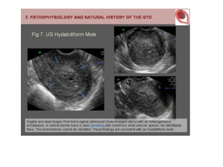 Role of mri in placental disorders new | PPTX