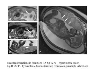 Role of mri in placental disorders new | PPTX