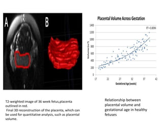 Role of mri in placental disorders new | PPTX