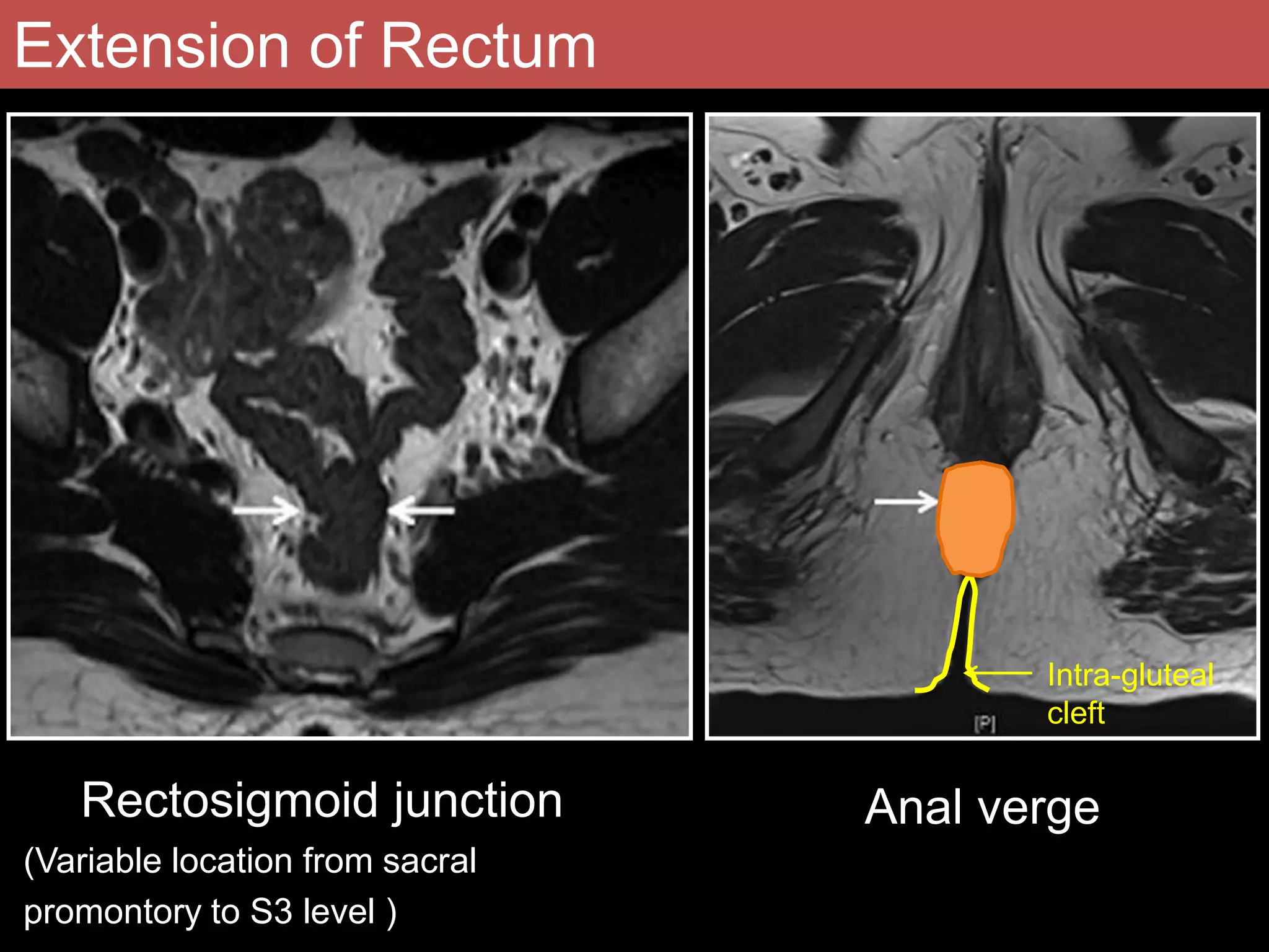 Role of mri in rectal carcinoma PPTX