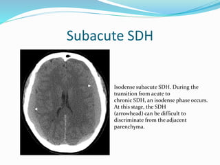 Role of mri in traumatic brain injury | PPT