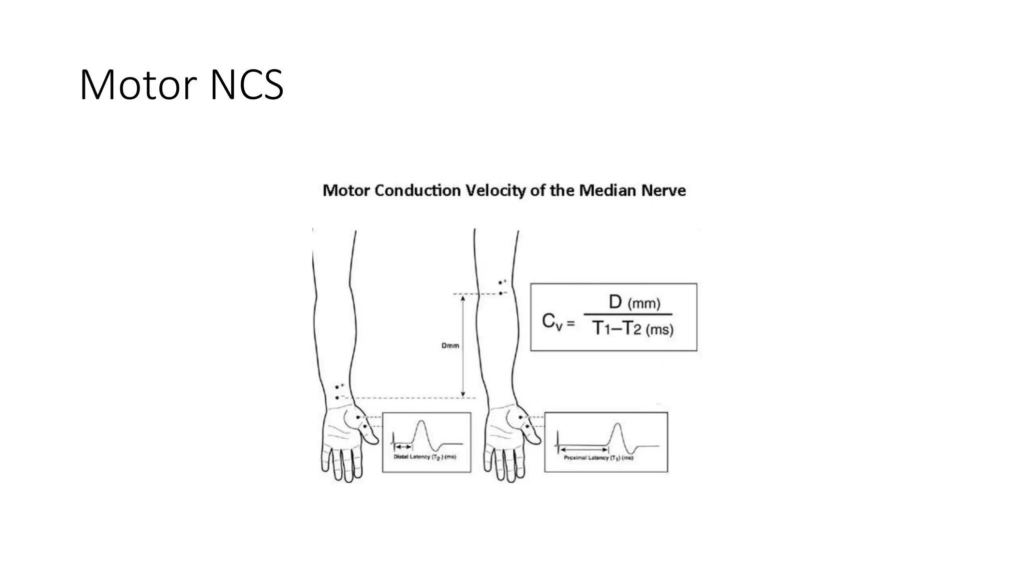 Role of NCS in Nerve injuries.pptx