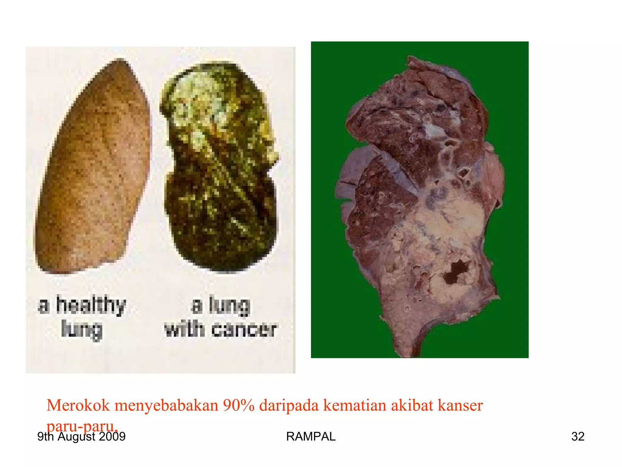 Merokok menyebabakan 90% daripada kematian akibat kanser  paru-paru, 9th August 2009 RAMPAL 