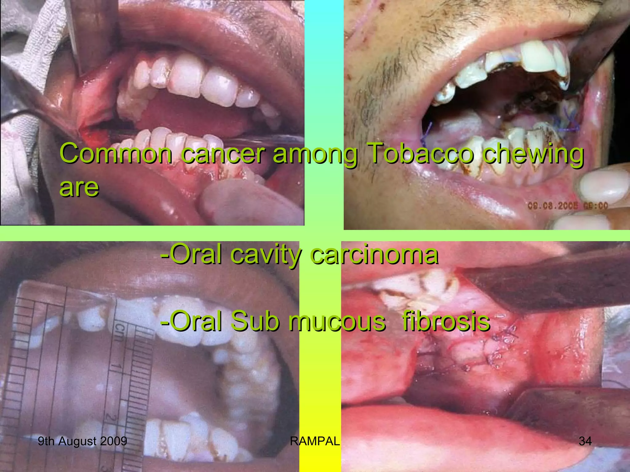 Common cancer among Tobacco chewing are     -Oral cavity carcinoma   -Oral Sub mucous  fibrosis 9th August 2009 RAMPAL 