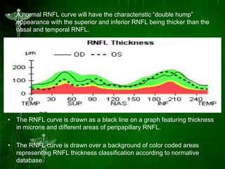 Normal Rnfl Image Role of oct in glaucoma | PPTX