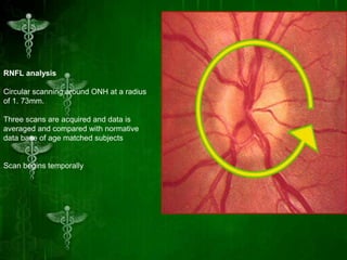 Role of oct in glaucoma | PPTX