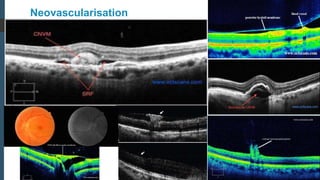 Neovascular Net On 5 Line Rastor Oct Role of oct in ophthalmology | PPTX