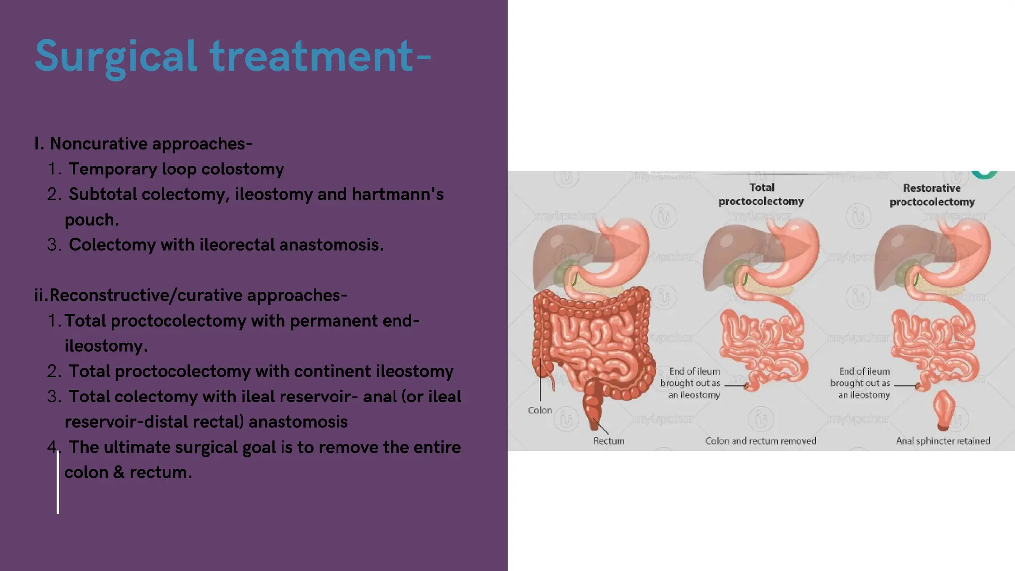 Surgical treatment-
I. Noncurative approaches-
Temporary loop colostomy
1.
Subtotal colectomy, ileostomy and hartmann's
pouch.
2.
Colectomy with ileorectal anastomosis.
3.
ii.Reconstructive/curative approaches-
Total proctocolectomy with permanent end-
ileostomy.
1.
Total proctocolectomy with continent ileostomy
2.
Total colectomy with ileal reservoir- anal (or ileal
reservoir-distal rectal) anastomosis
3.
The ultimate surgical goal is to remove the entire
colon & rectum.
4.
 