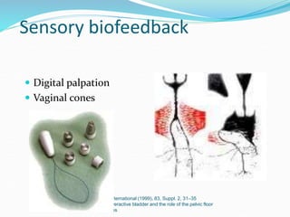 Sensory biofeedback
 Digital palpation
 Vaginal cones
BJU International (1999), 83, Suppl. 2, 31–35
The overactive bladder and the role of the pelvic floor
muscles
 