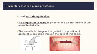 Maxillary Ramps ROLE OF PROSTHODONTIC REHABILITATION AFTER SURGERY OF ORAL.pptx