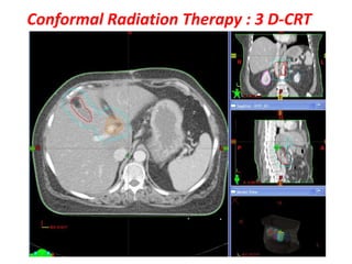 Cd R Radiotherapy Role of radiotherapy and chemotherapy in ca gall bladder | PPTX