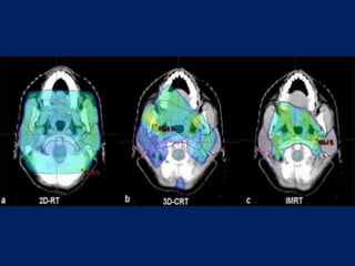 Role of radiotherapy and chemotherapy in oral cavity cancer | PPTX