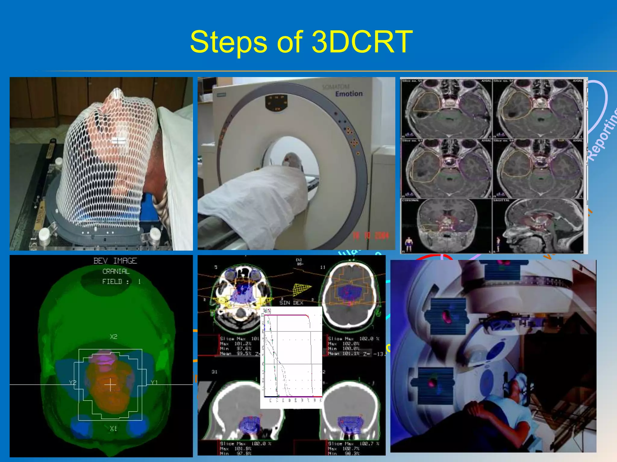 Role of radiotherapy in brain tumours | PPTX