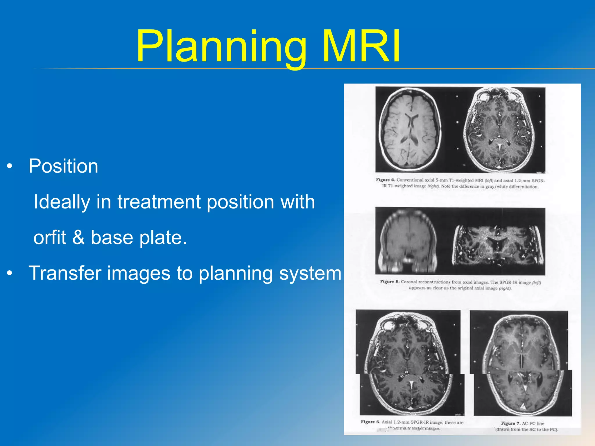Brain Radiotherapy Card Role of radiotherapy in brain tumours | PPTX