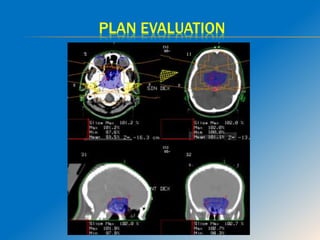 Brain Radiotherapy Card Role of radiotherapy in brain tumours | PPTX