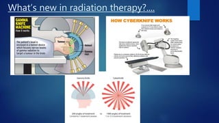 Role of radiotherapy in oral ca ppt for csm | PPTX