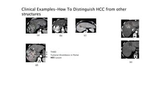 Hcc Structure Example Role of Radiotherapy in Primary and Metastatic Liver Tumors | PPTX