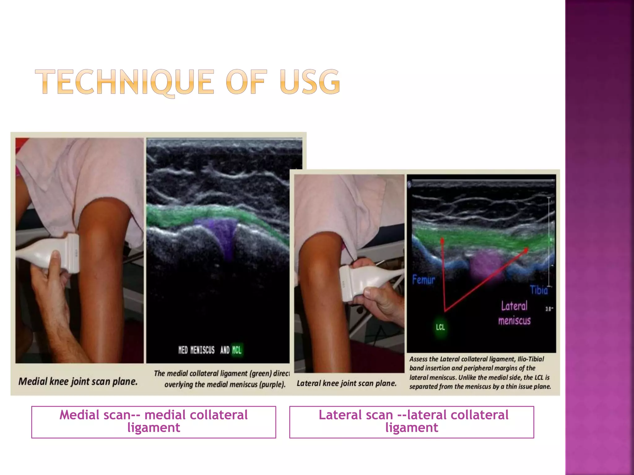 Role of sonography in knee joint diseases | PPT