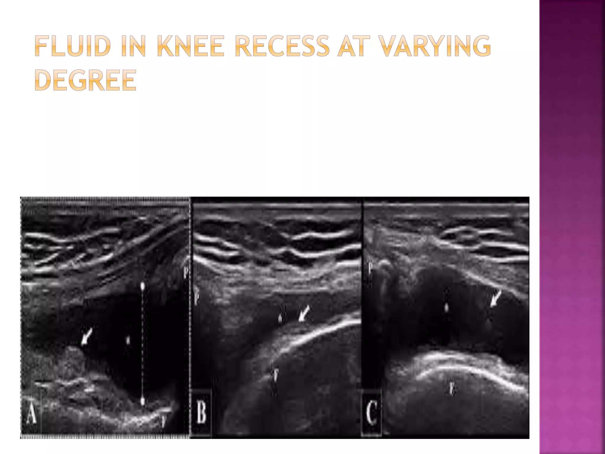 Role of sonography in knee joint diseases | PPT