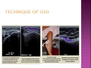 Role of sonography in knee joint diseases | PPT