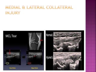 Role of sonography in knee joint diseases | PPT