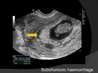 Subchorionic Infarct Role of tvs in early pregnancy | PPTX