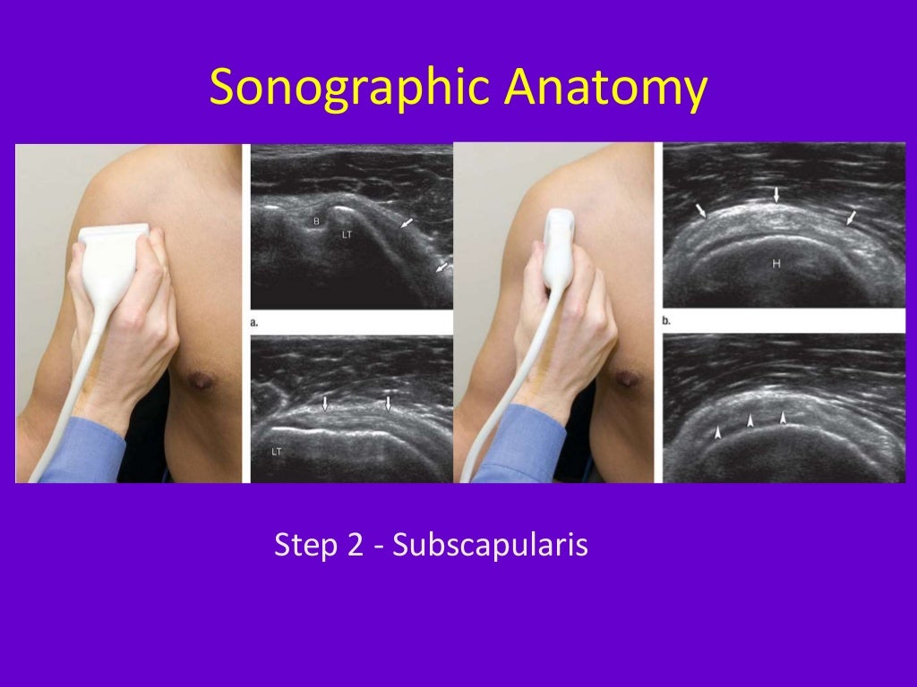 Role of ultrasound in clinical evaluation of shoulder Dr. Muhammad Bi…
