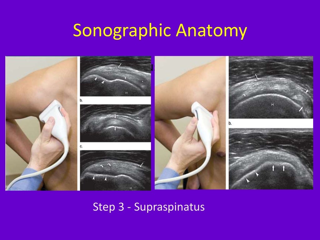 Role of ultrasound in clinical evaluation of shoulder Dr. Muhammad Bi…