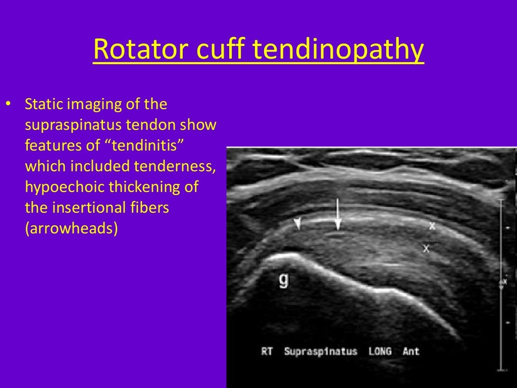 Role of ultrasound in clinical evaluation of shoulder Dr. Muhammad Bi…