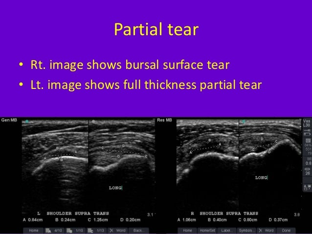 Role of ultrasound in clinical evaluation of shoulder Dr. Muhammad Bi…