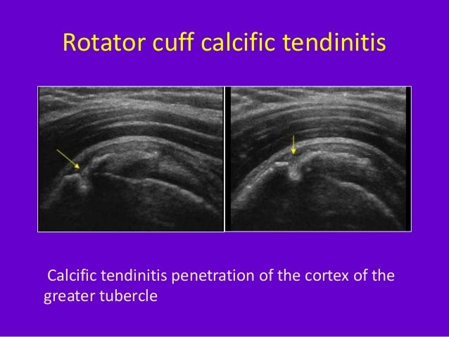 Role of ultrasound in clinical evaluation of shoulder Dr. Muhammad Bi…