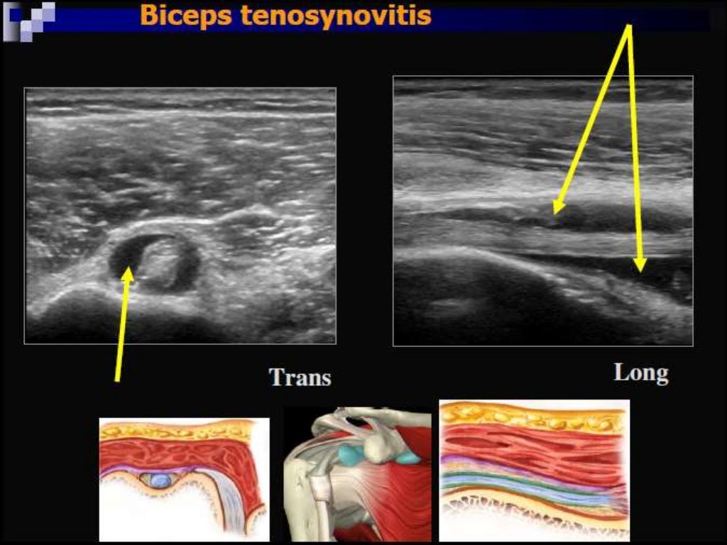 Role of ultrasound in clinical evaluation of shoulder Dr. Muhammad Bi…