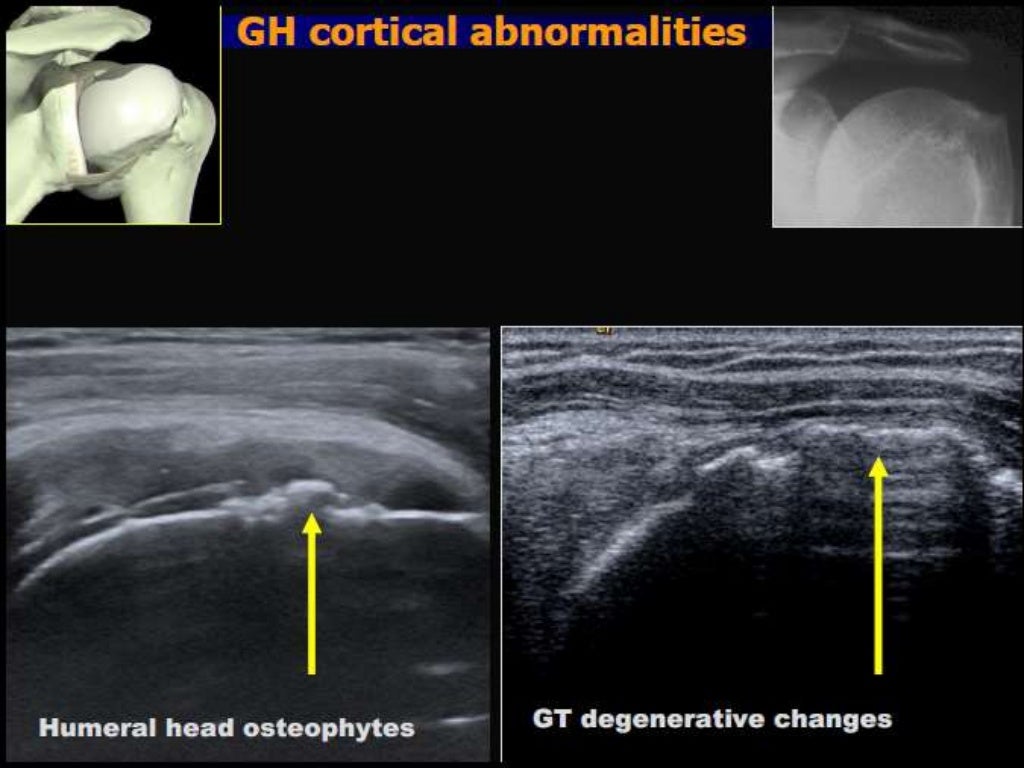 Role of ultrasound in clinical evaluation of shoulder Dr. Muhammad Bi…