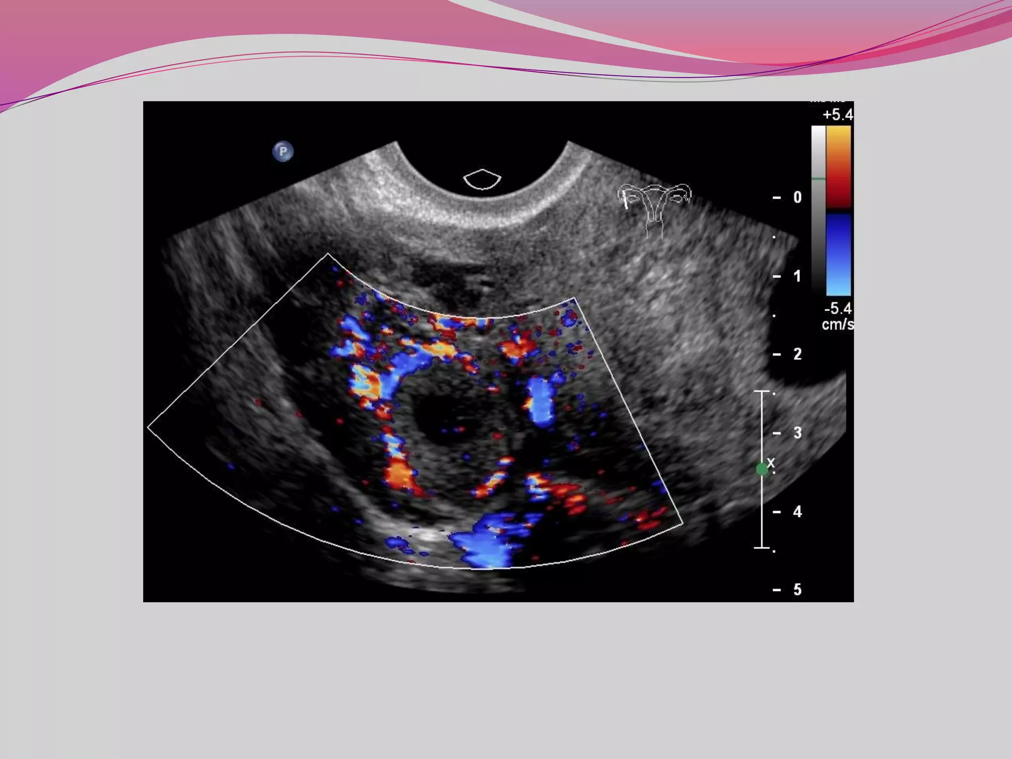 Role of ultrasound in emergency obstetrics . | PPTX